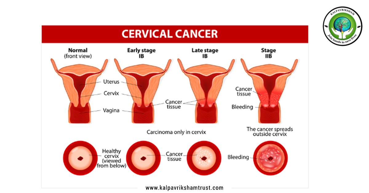 Cervical Cancer in chennai